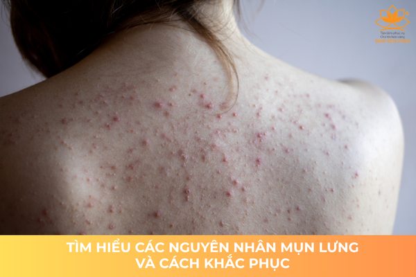Tìm Hiểu Nguyên Nhân Gây Ra Mụn Lưng Và Cách Khắc Phục 